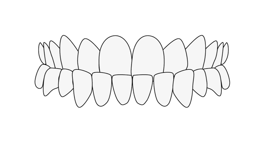 Nieprawidłowe ustawienie zębów: zgryz prosty new
